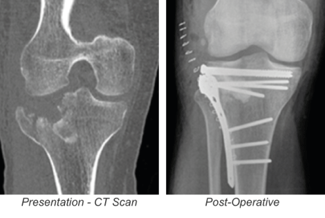 Use Of Genex In The Treatment Of A Tibial Plateau Fracture